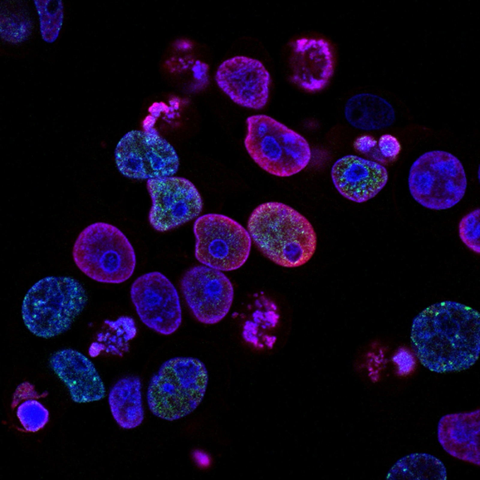Prostate cancer - Detection and treatment